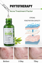 Tea tree essence bottle with before, during, and after effects on skin, labeled 'Phytotherapy Acne Treatment Factor'.